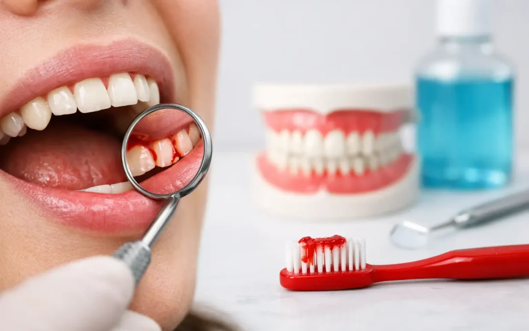 Why Are My Gums Bleeding? Common Causes