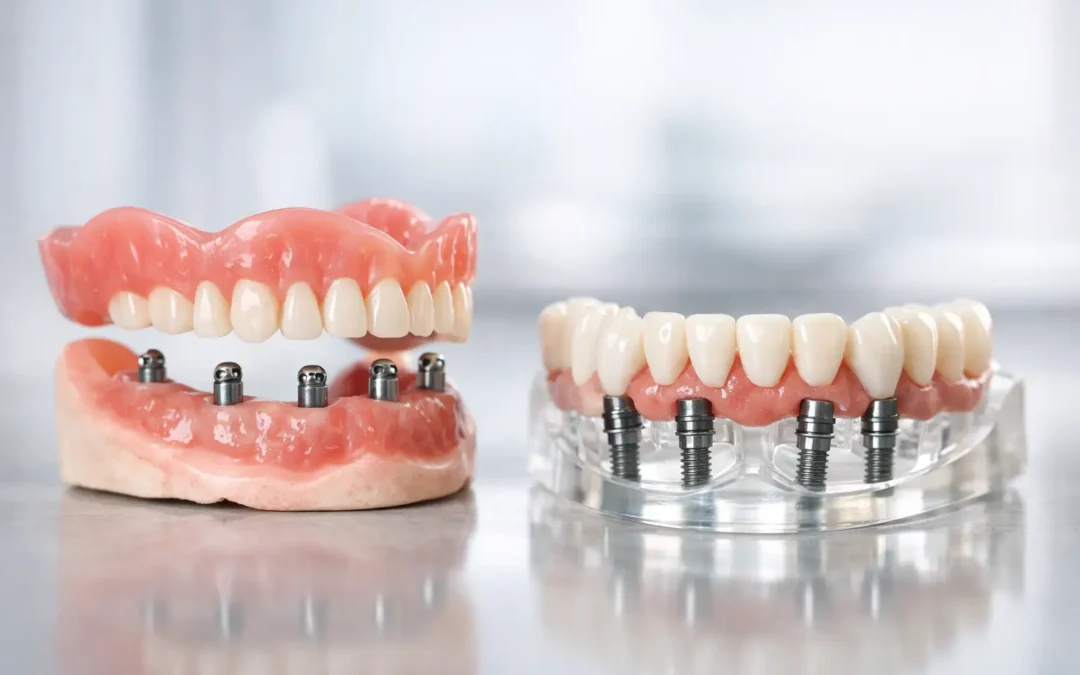 Implant Supported Dentures Comparison