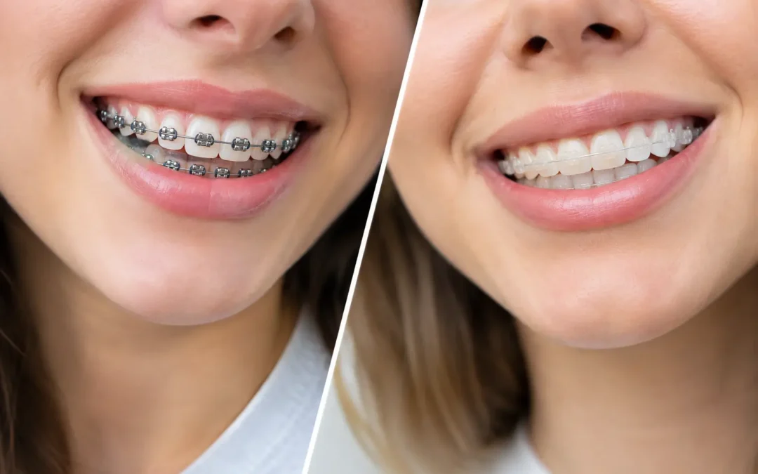 Metal Braces vs Ceramic: Which Is Right?